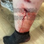 На Грабнику у Рівному жінку несподівано вкусив собака