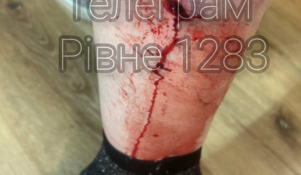 На Грабнику у Рівному жінку несподівано вкусив собака